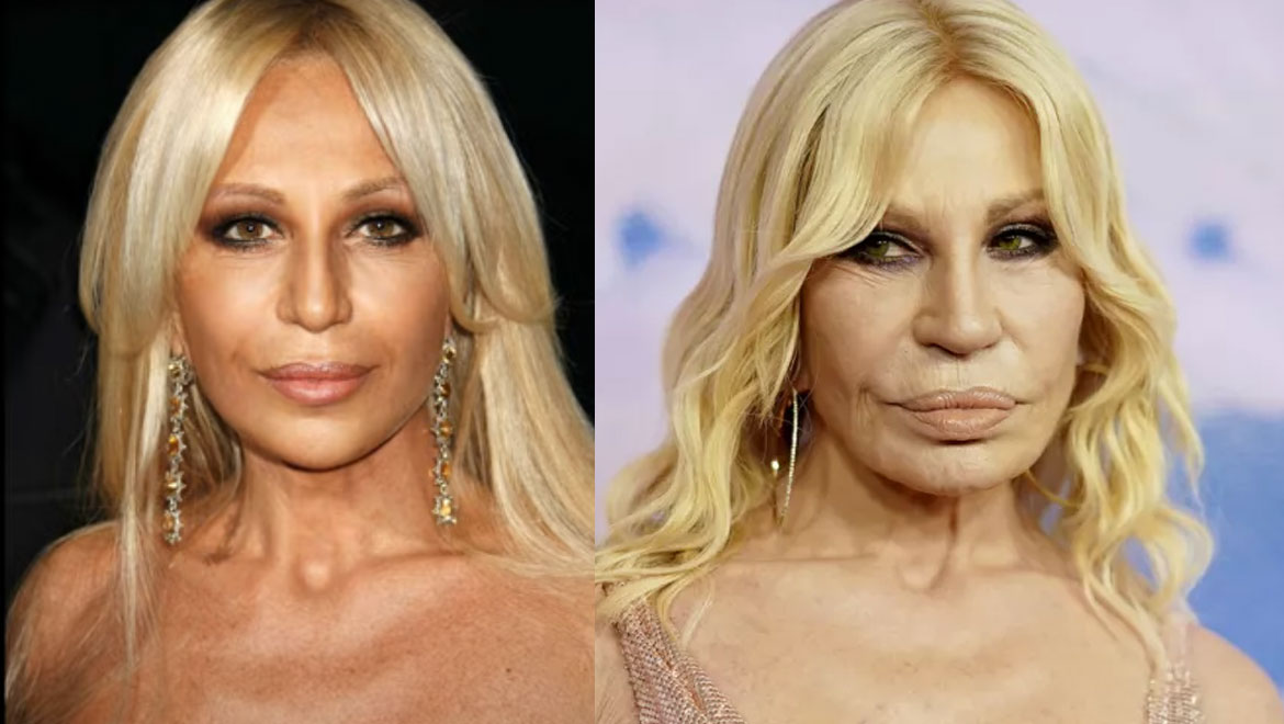 Η Donatella Versace αγνώριστη μετά τις αλλεπάλληλες πλαστικές επεμβάσεις.