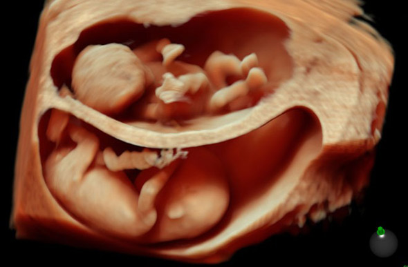 3d-ultrasound-3-