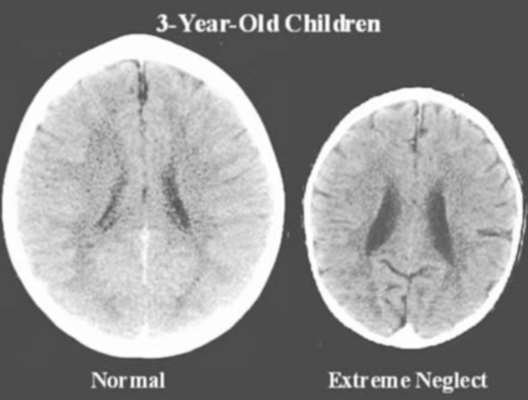 brain_scan_neglect